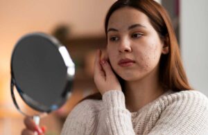 ¿Para qué sirve el ácido azelaico y cómo usarlo correctamente en tu rutina facial?